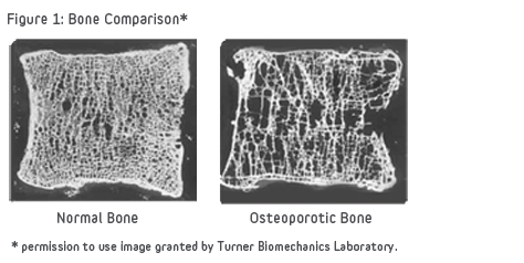 Bone_Comparison_of_Healthy_and_Osteoporotic_Vertibrae